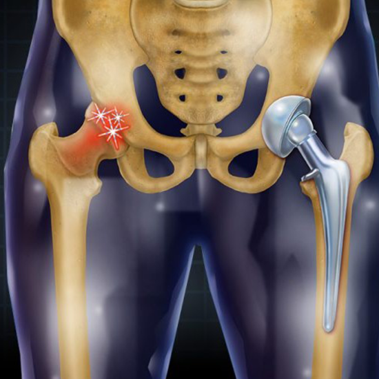 Total Hip Replacement